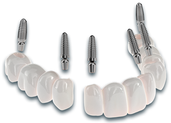 Dental Implant Surgery: A Comprehensive Guide